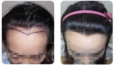 種植發(fā)際線要多少錢