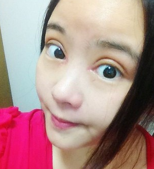 全切雙壓迫+開眼角 擁有明亮又美麗的大眼美眉