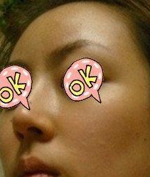 隆鼻手術(shù)  實現(xiàn)更美的自己