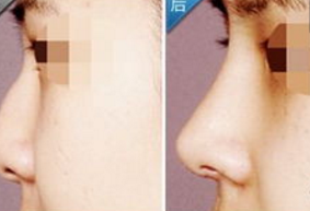 隆鼻失敗的表現(xiàn)有哪些