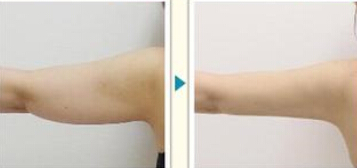 手臂吸脂術(shù)有什么優(yōu)點 - 珍美網(wǎng)