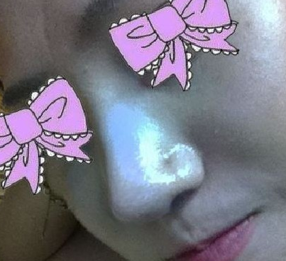 隆鼻手術(shù) 讓我更加活潑開朗啦