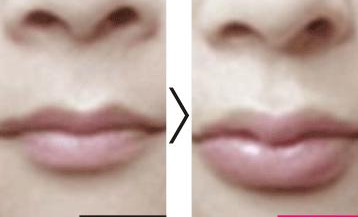 豐唇手術(shù)方法有哪幾種 - 珍美網(wǎng)