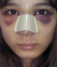 隆鼻手術(shù)  讓我更加充滿信心 - 珍美網(wǎng)