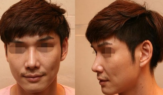 隆鼻手術(shù)  我的印象分也大大增值了 - 珍美網(wǎng)