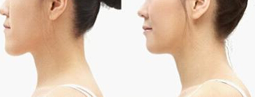 地包天矯正后的注意事項(xiàng)有哪些?