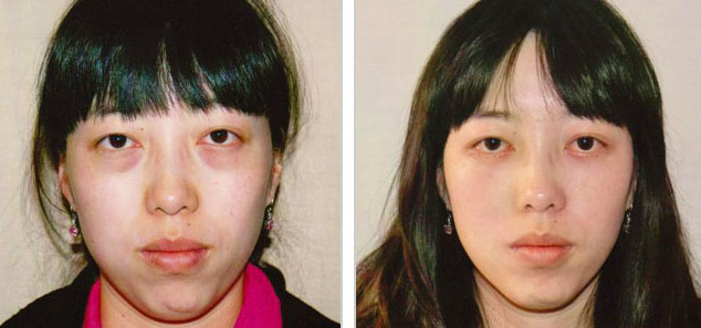 激光去眼袋有哪些副作用 - 珍美網(wǎng)