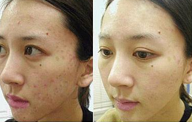 激光祛痘效果怎么樣