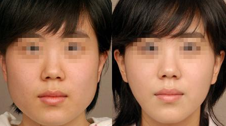 面部整形價(jià)格和哪些因素有關(guān) - 珍美網(wǎng)