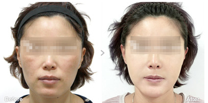 做射頻緊膚除皺會不會反彈?