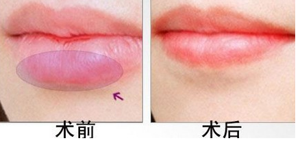 厚唇改薄后遺癥大嗎
