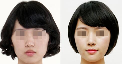 自體脂肪填充面部對身體有影響嗎