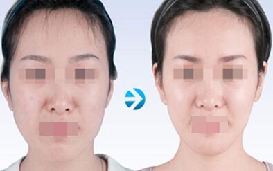 玻尿酸豐太陽穴能維持多久呢