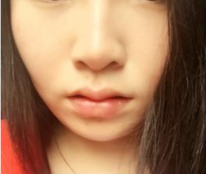 長沙雅美醫(yī)療美容醫(yī)院袁妍妍醫(yī)生豐唇案例：嘟嘟唇 - 珍美網(wǎng)