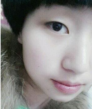 南京醫(yī)科大學(xué)第二附屬醫(yī)院整形美容中心李昌醫(yī)生割雙眼皮案例:割 - 珍美網(wǎng)