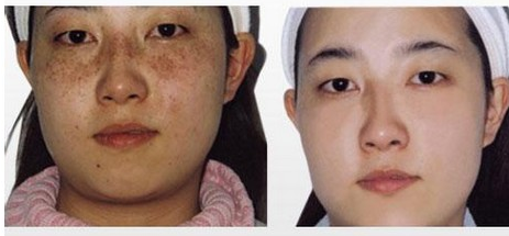 彩光祛斑價(jià)格受哪些因素影響 - 珍美網(wǎng)