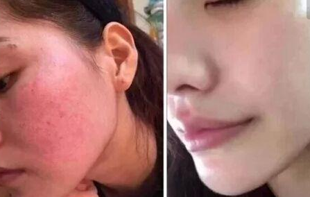 去紅血絲的美容方式有哪些? - 珍美網(wǎng)