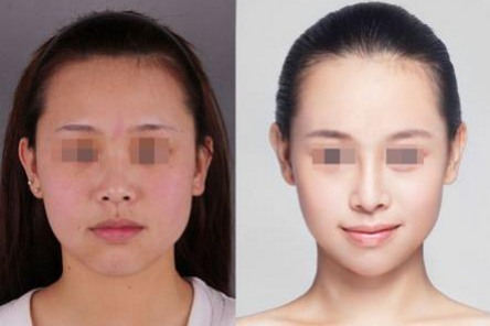 彩光嫩膚術(shù)對皮膚有沒有傷害