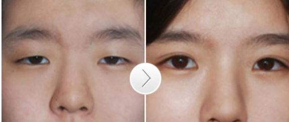 韓式雙眼皮術(shù)后需要注意哪些問題 - 珍美網(wǎng)