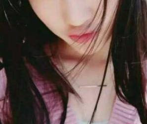 蘇州工業(yè)園區(qū)瑞芙臣醫(yī)療美容診所徐增亮醫(yī)生瘦臉案例：瘦臉針