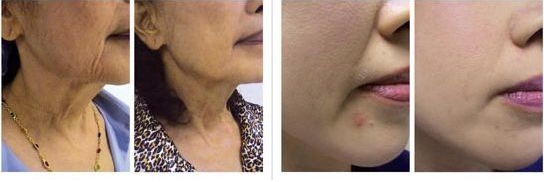 電波拉皮有哪三大特色