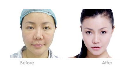 光子嫩膚手術可能出現(xiàn)的副作用有哪些