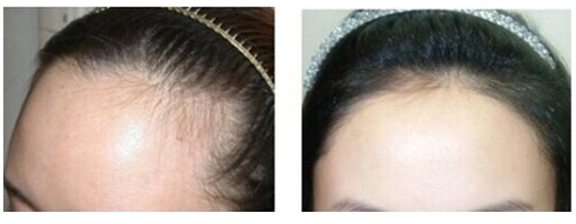 發(fā)際線后移越來越高的原因有哪些