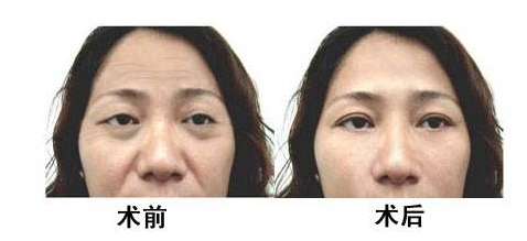 電波拉皮除皺后會不會反彈