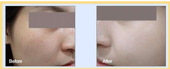 水光針嫩膚效果如何?