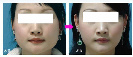 改臉型手術(shù)風(fēng)險(xiǎn)大不大呢