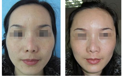 自體脂肪移植豐額頭適應人群有哪3種 - 珍美網(wǎng)