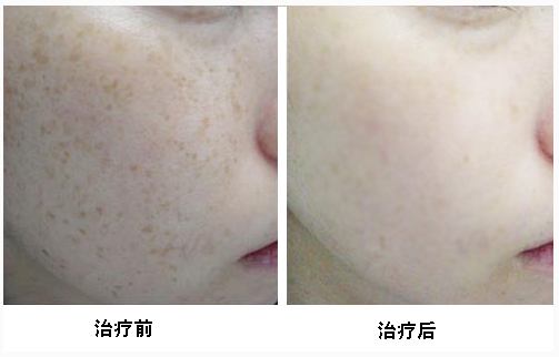 彩光祛斑好處有哪些 - 珍美網(wǎng)