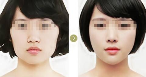 改臉型手術(shù)疼不疼