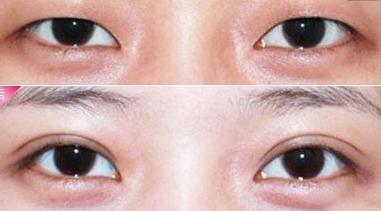 埋線雙眼皮恢復期是多久? - 珍美網(wǎng)
