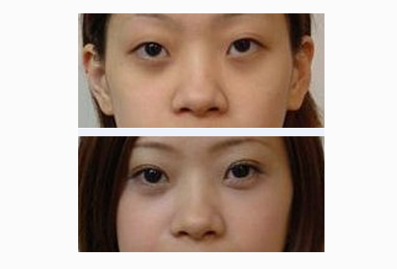 割雙眼皮術(shù)后能吃止痛藥嗎 - 珍美網(wǎng)