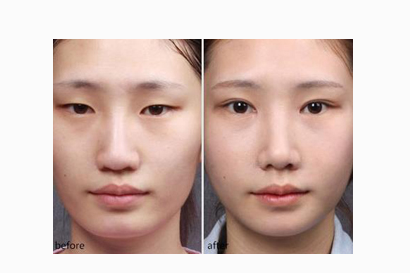 開(kāi)眼角有沒(méi)有后遺癥呢