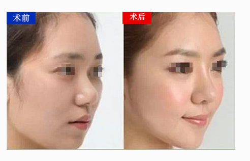 自體脂肪豐蘋果肌恢復(fù)需要多長時(shí)間 - 珍美網(wǎng)