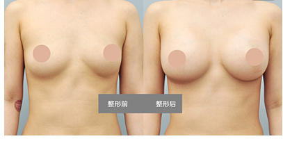 自體脂肪隆胸手術(shù)后手感自然嗎