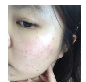 激光祛痘 讓我青春活力每一天 - 珍美網(wǎng)