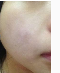 激光祛痘 讓我青春活力每一天