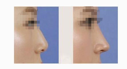 注射隆鼻是否有疼痛感呢