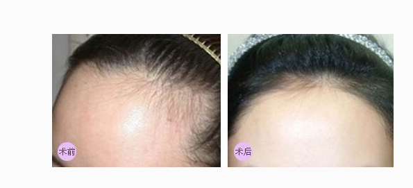 激光脫發(fā)際線會不會傷害皮膚呢