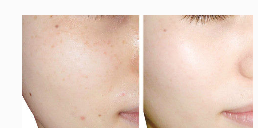 黑臉娃娃做完需要多長時(shí)間才有效果