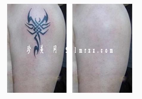 激光去紋身效果好不好呢 - 珍美網(wǎng)