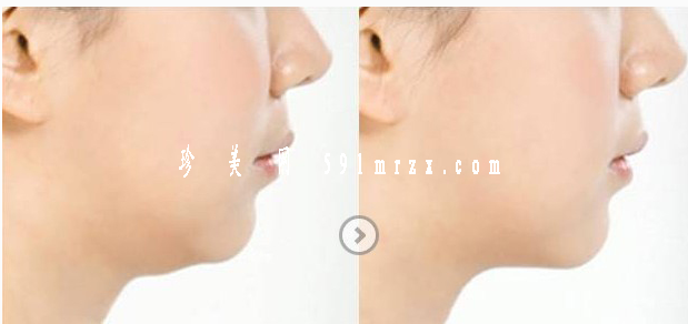 面部吸脂瘦臉多長時間可以恢復正常呢 - 珍美網(wǎng)