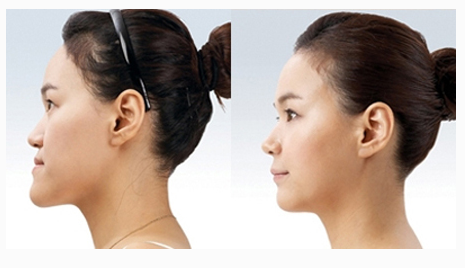 地包天牙齒矯正有沒(méi)有年齡限制呢