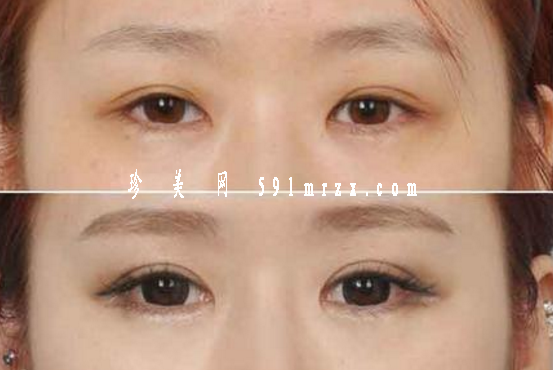 開(kāi)眼角手術(shù)后如何快速消腫呢