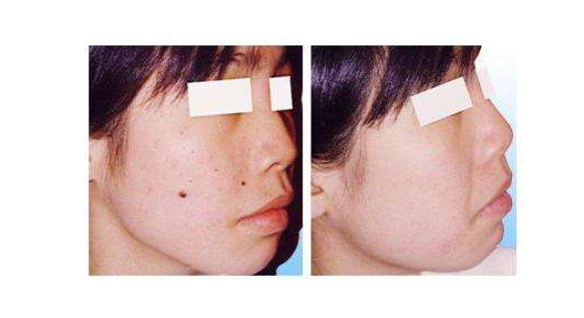 激光去痣價(jià)格是多少呢