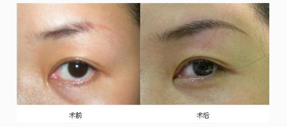 眉毛整形手術(shù)方法有哪些呢