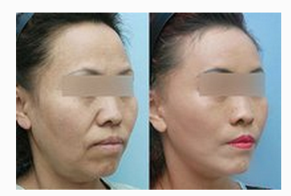 電波拉皮手術(shù)后會有副作用嗎